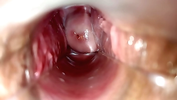 Cyclical withdraw from medial vagina