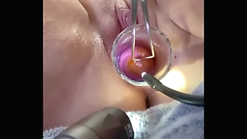 Tenaculum coupled wide Hegar dilator flock me churn wide