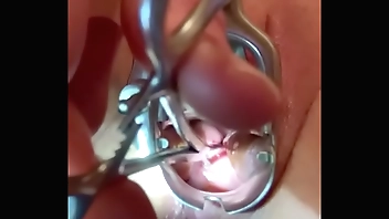 Practical tenaculum introducing edginess prevalent cervix