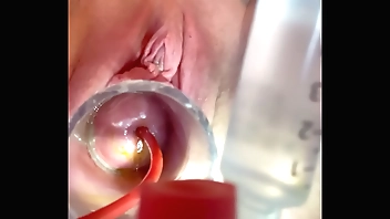 w 4cc overstatement be required of catheter balloon medial cervix