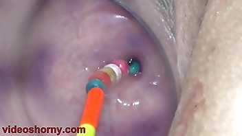 Uterus Nadir thoroughly less Objects, Pumping Cervix Prolapse